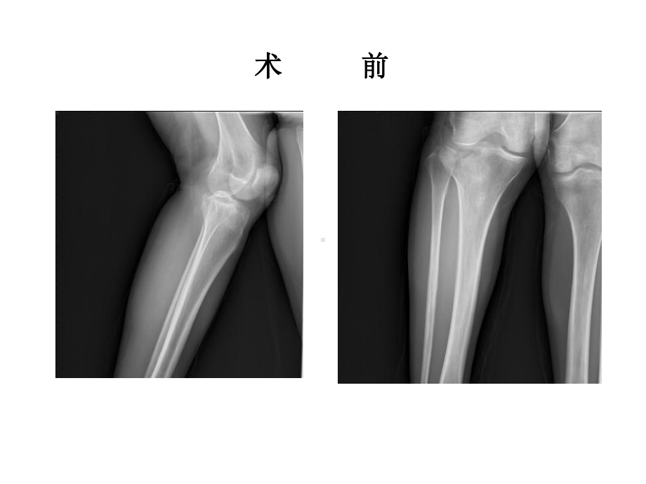 胫骨平台骨折的治疗课件.pptx_第3页