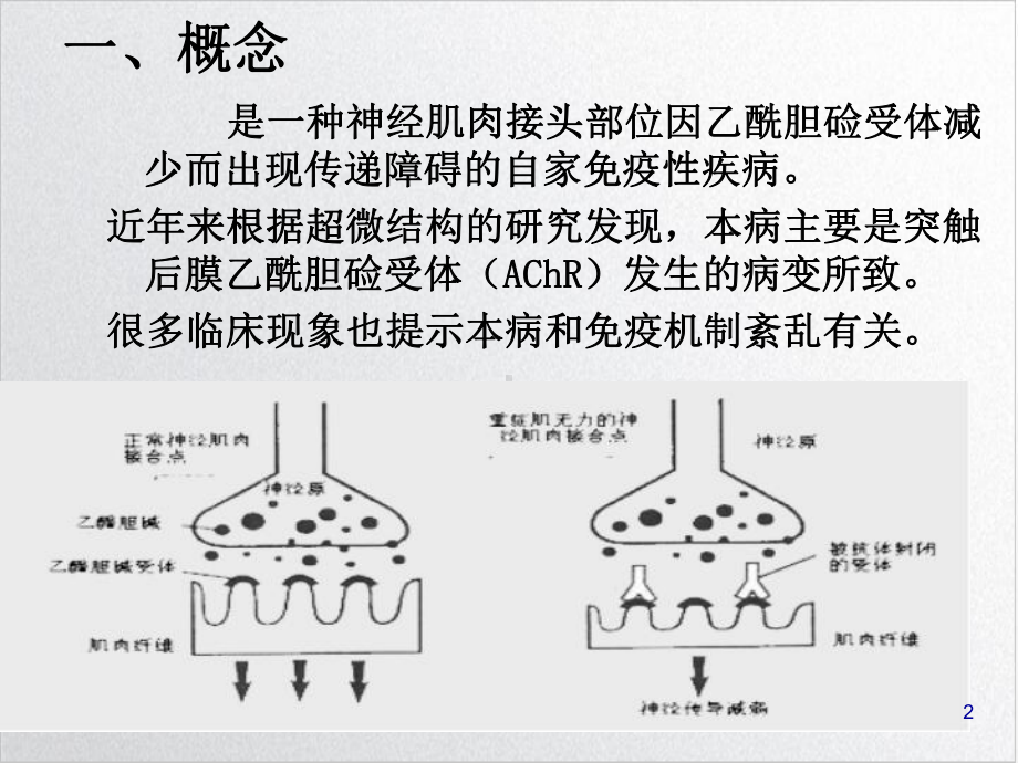 重症肌无力的护理课件-3.ppt_第2页