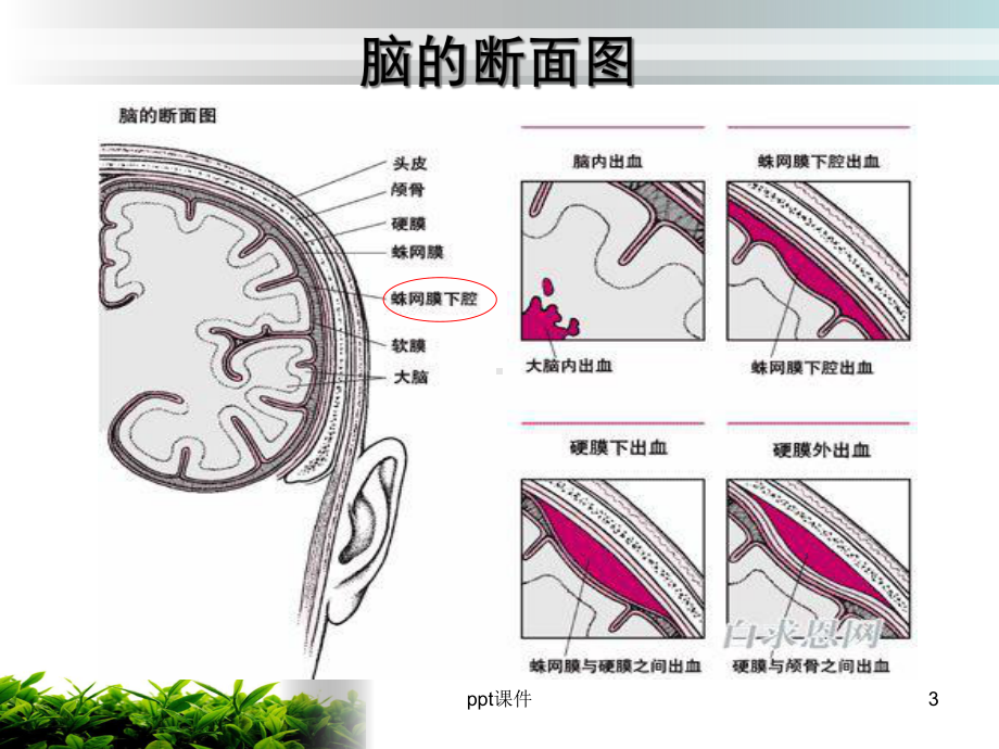 脑脊液耳漏-课件.ppt_第3页