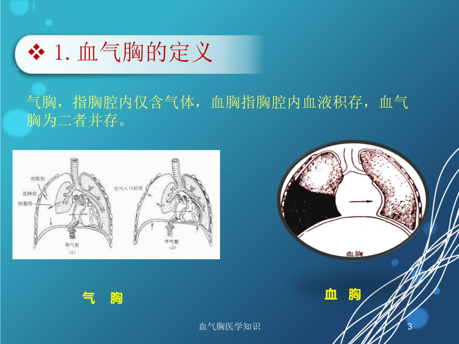 血气胸医学知识培训课件.ppt_第3页