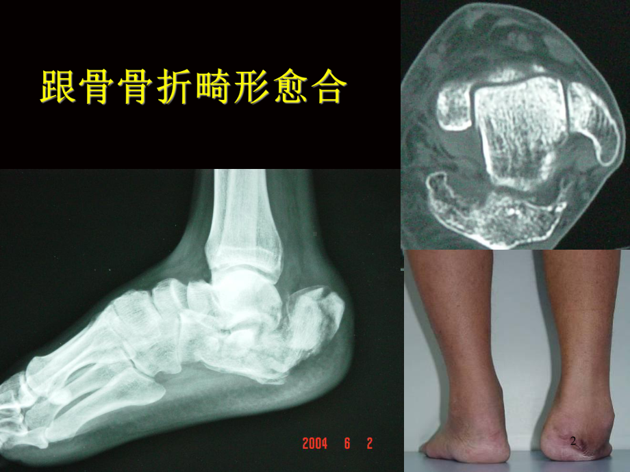 跟骨畸形愈合治疗课件-2.ppt_第2页