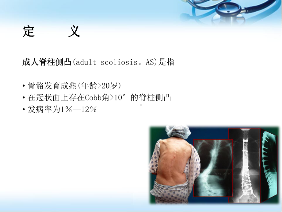 退变性成人脊柱侧凸参考课件.ppt_第2页