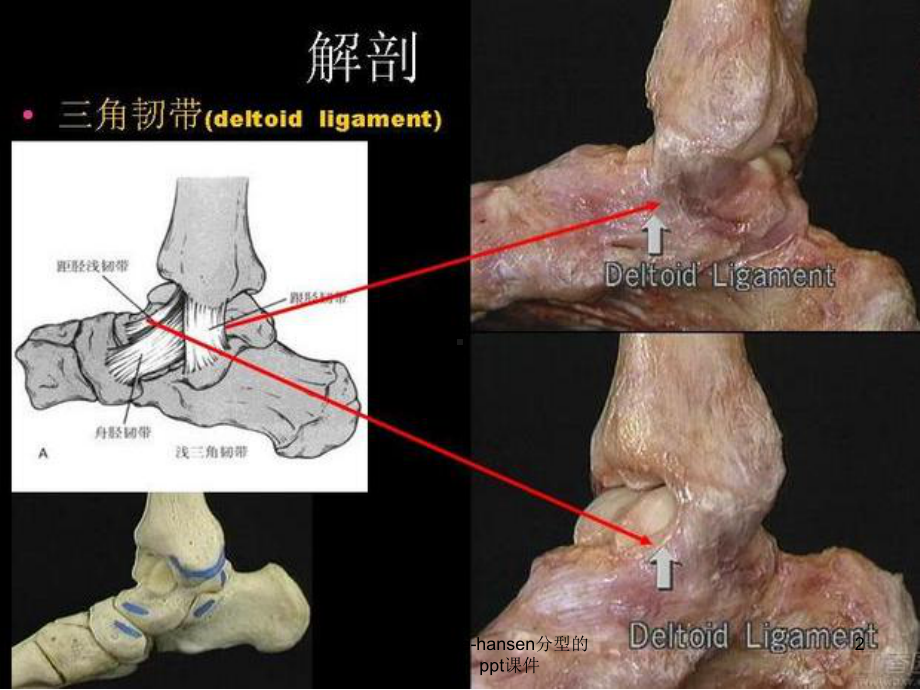 踝关节骨折Laugehansen分型的理解与评价-课件.pptx_第2页