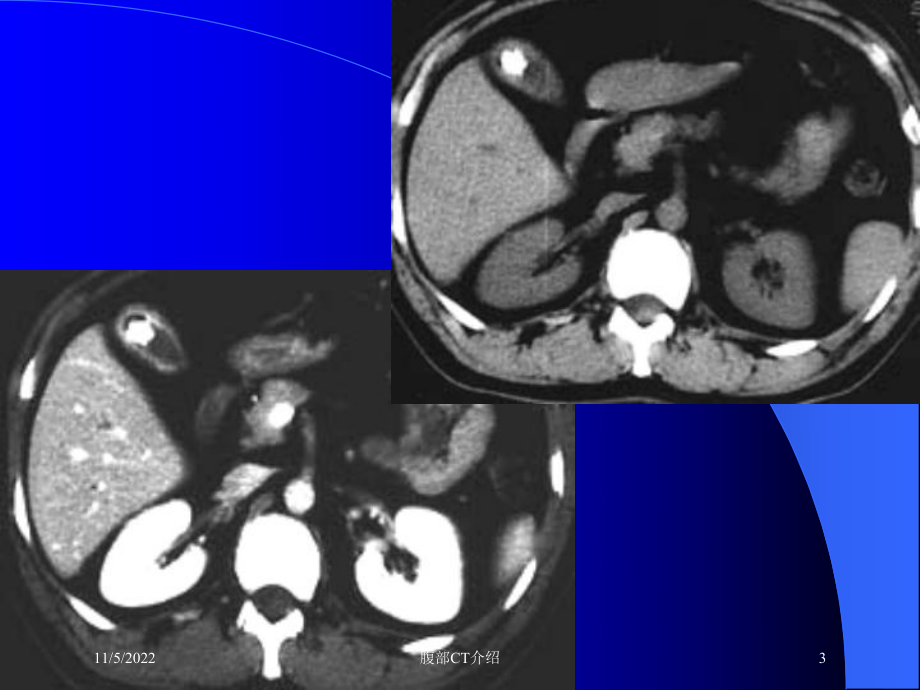 腹部CT介绍培训课件.ppt_第3页
