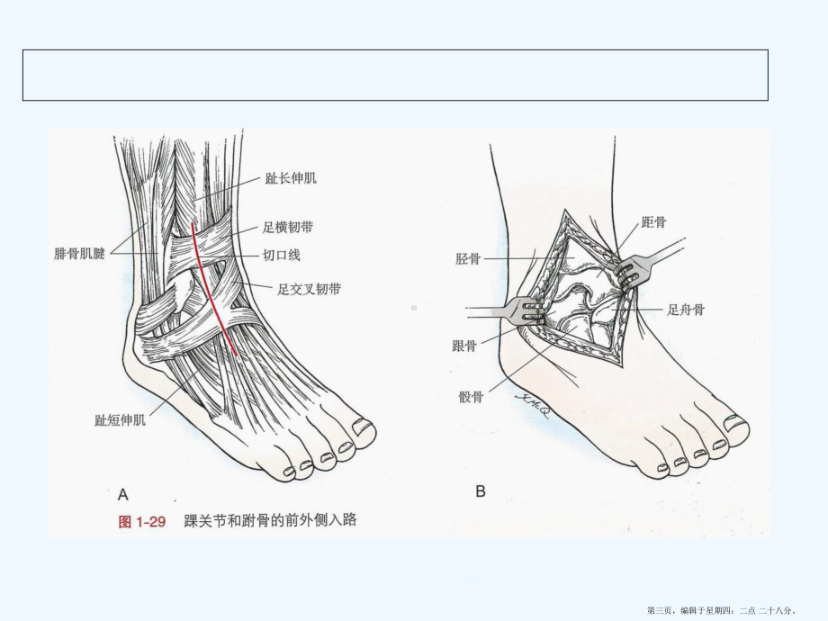 踝关节手术入路课件.ppt_第3页