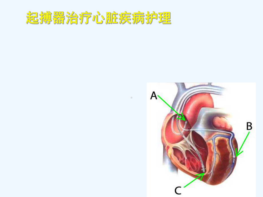 起搏器治疗心脏疾病护理课件.ppt_第1页