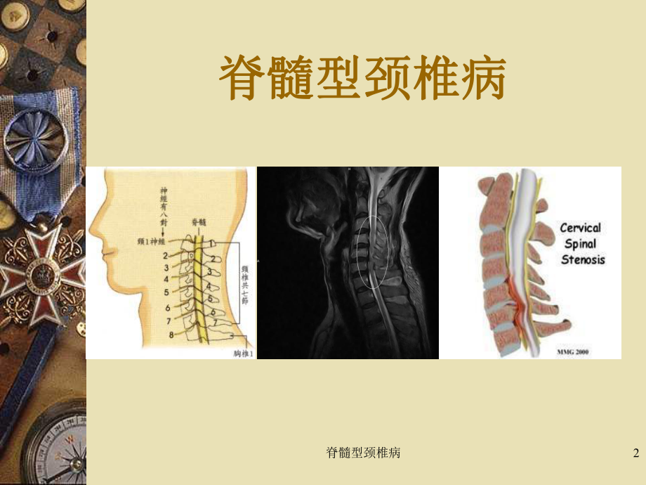 脊髓型颈椎病培训课件.ppt_第3页