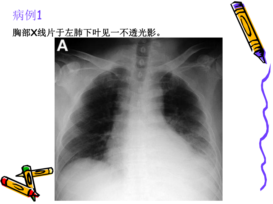 自发性食管破裂的临床诊治教材课件.ppt_第3页