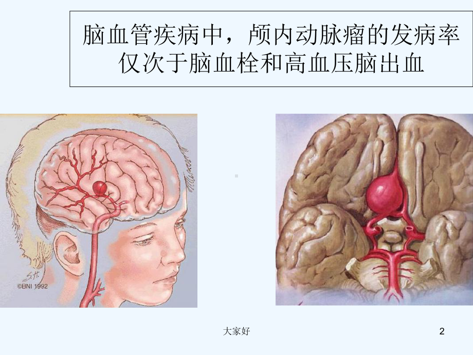 脑动脉瘤手术配合-课件.ppt_第2页