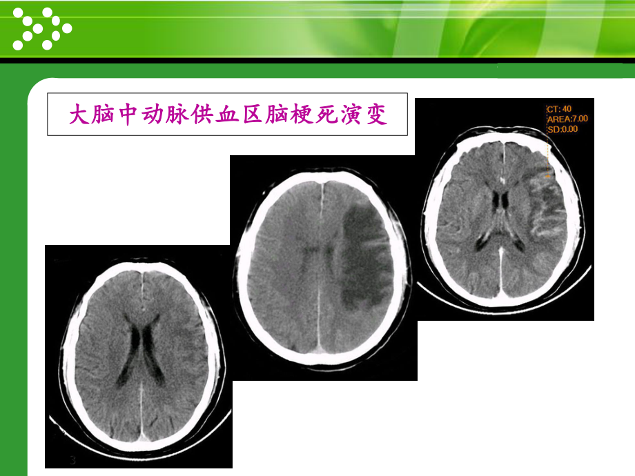 脑卒中康复87551课件.ppt_第3页