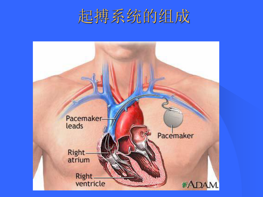 起搏器术中并发症讲义课件.ppt_第2页