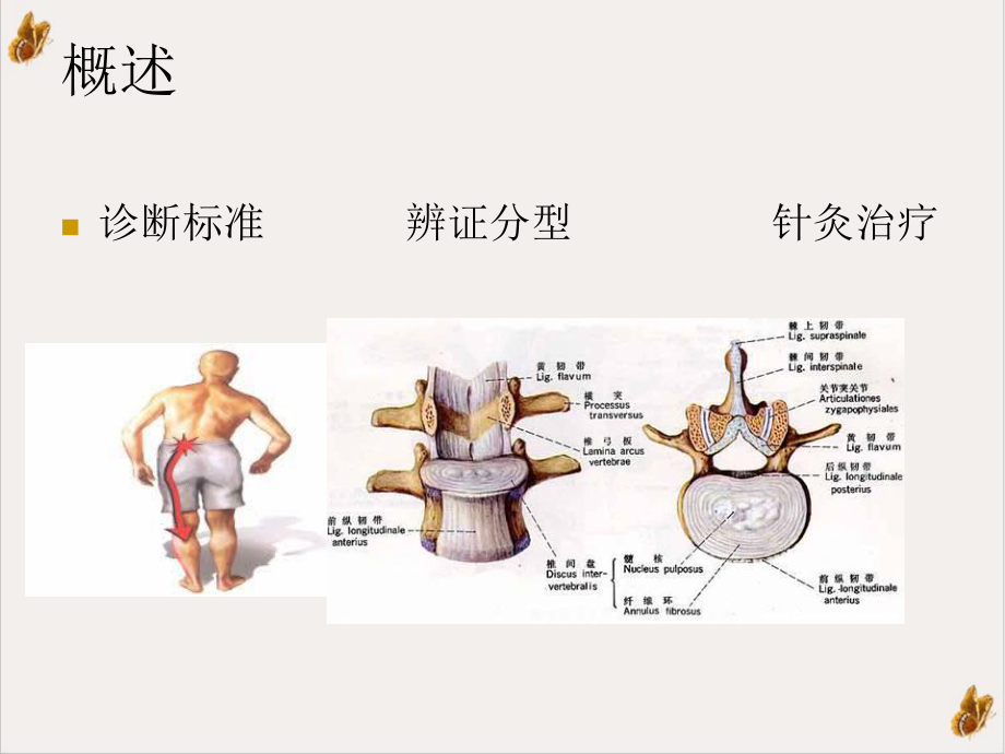 腰椎间盘突出症的针灸治疗课件.ppt_第2页