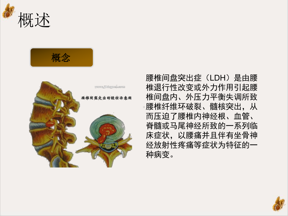 腰椎间盘突出症的针灸治疗课件.ppt_第3页