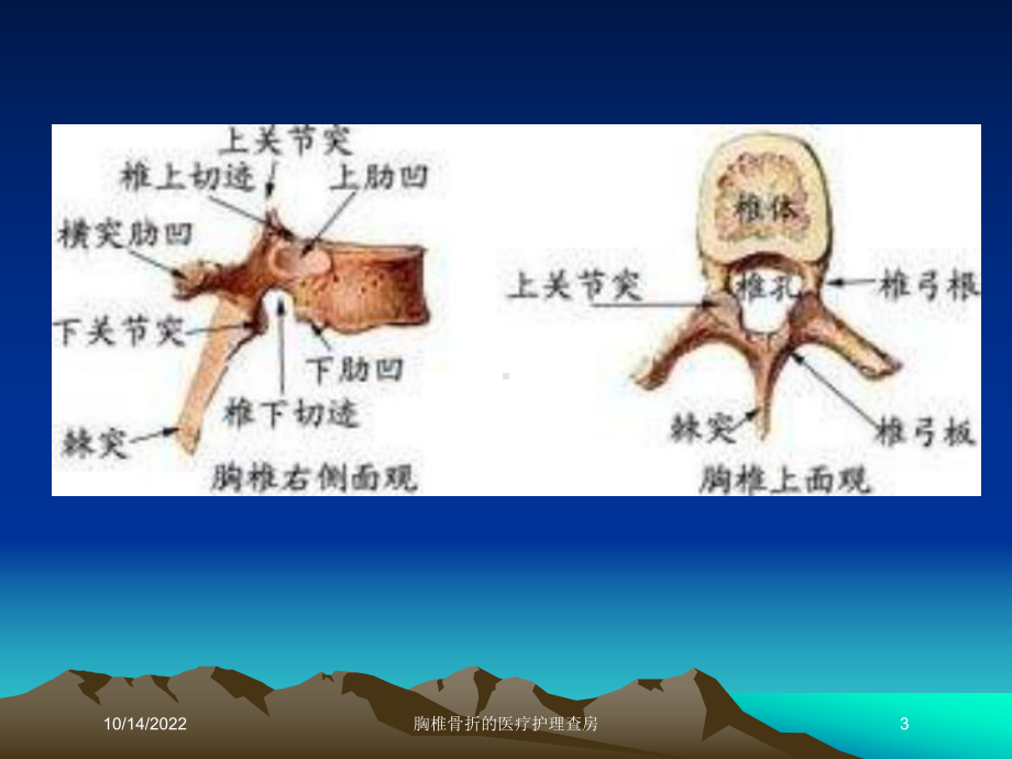 胸椎骨折的医疗护理查房培训课件.ppt_第3页