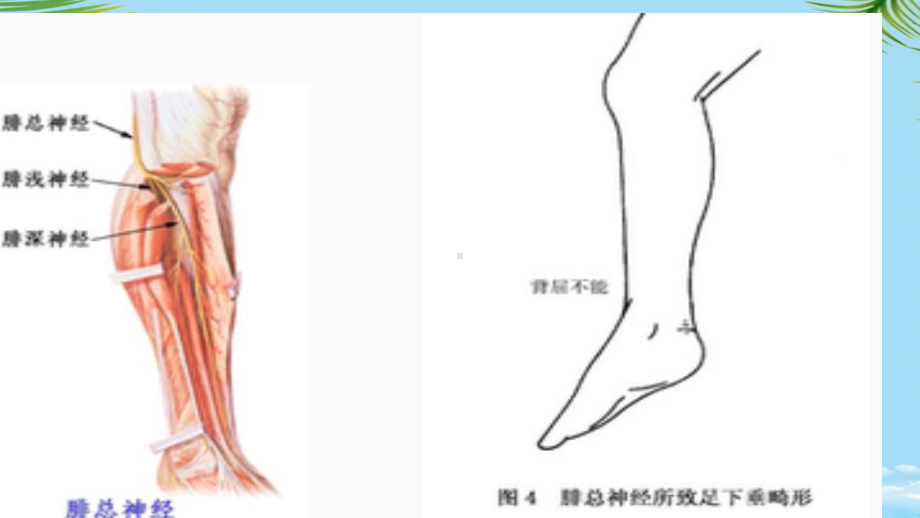 腓总神经损伤案例分析课件.pptx_第3页