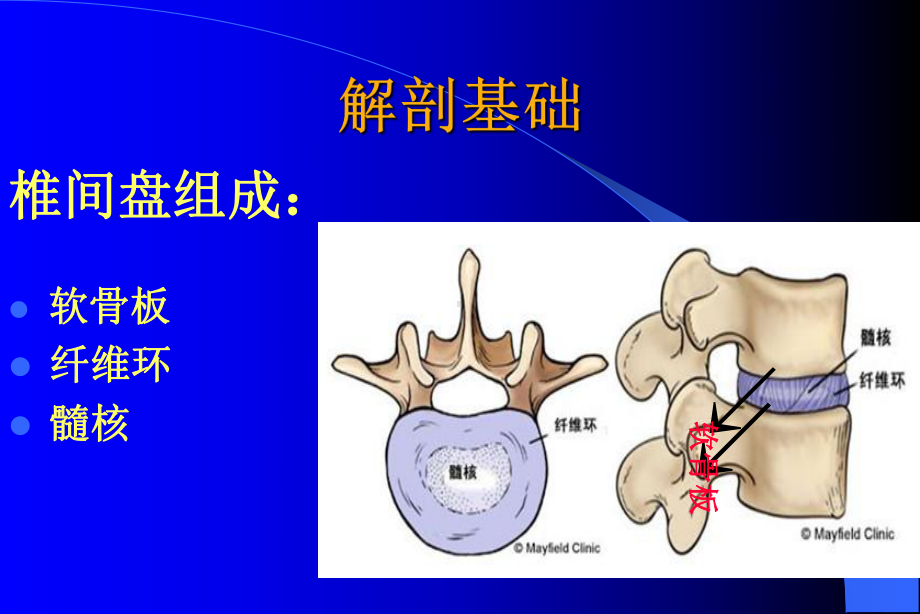 腰椎间盘突出症介绍课件.pptx_第3页