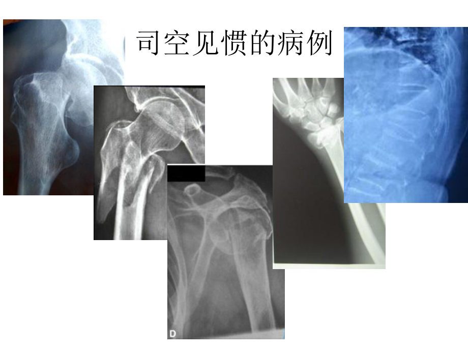 脆性骨折的医学处理（可编辑的）课件.ppt_第2页