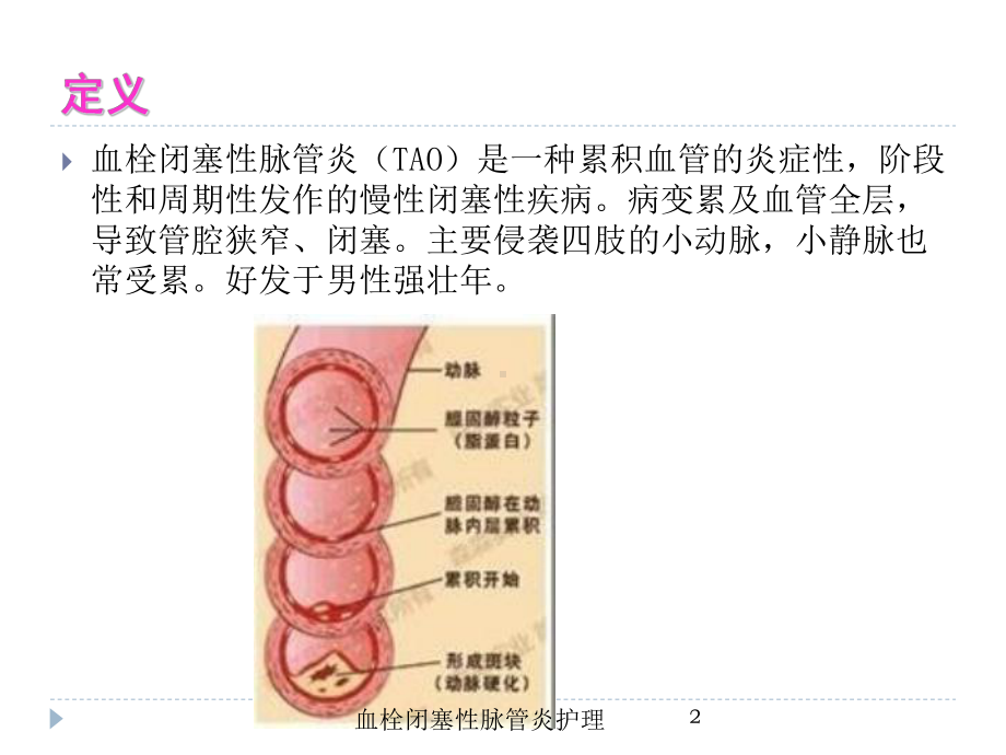 血栓闭塞性脉管炎护理培训课件.ppt_第2页