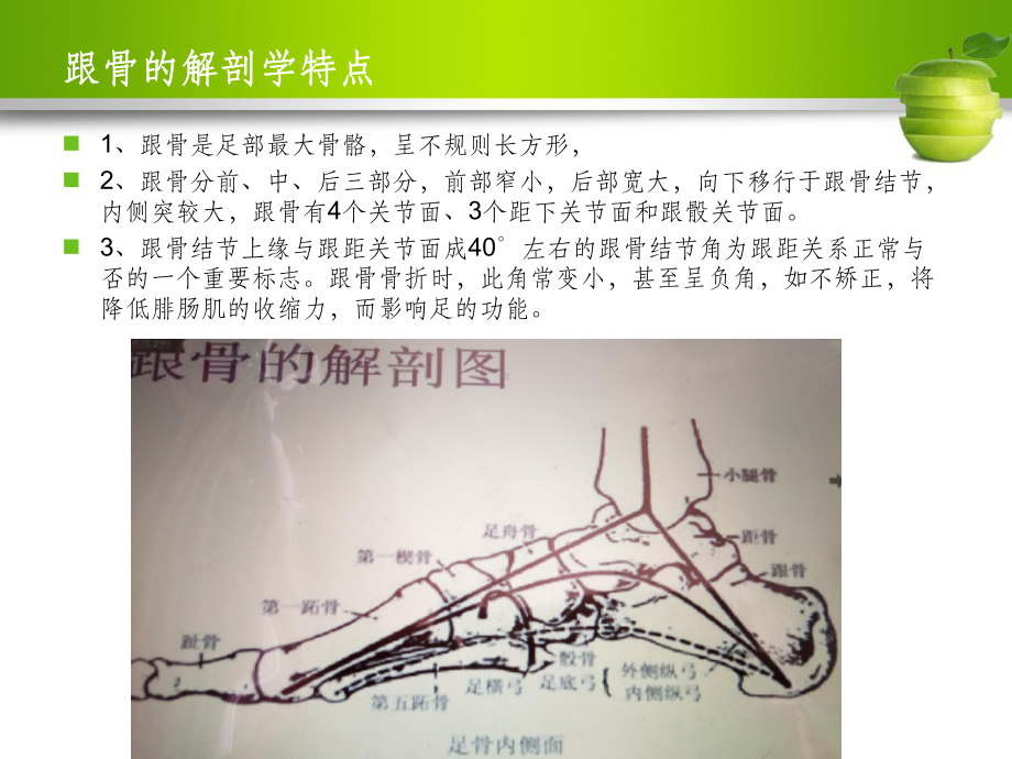 跟骨骨折护理查房课件-2.ppt_第3页