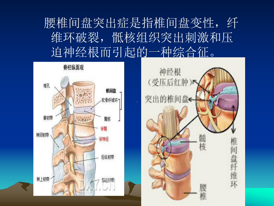 腰椎间盘突出症术前术后指导课件.pptx_第2页