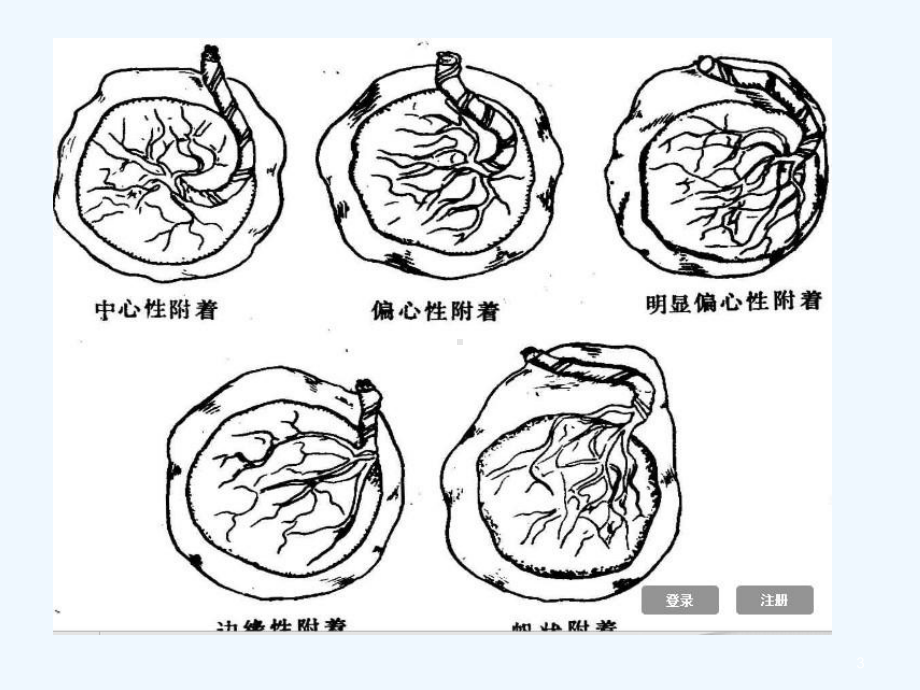 胎盘插入异常-课件.ppt_第3页