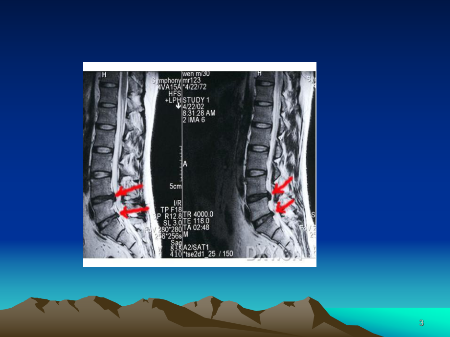 腰椎间盘突出症术前术后指导课件.ppt_第3页