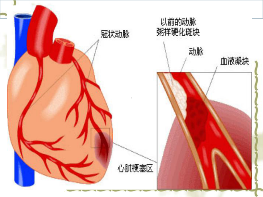 急性心肌梗死的急救护理课件2.ppt_第1页