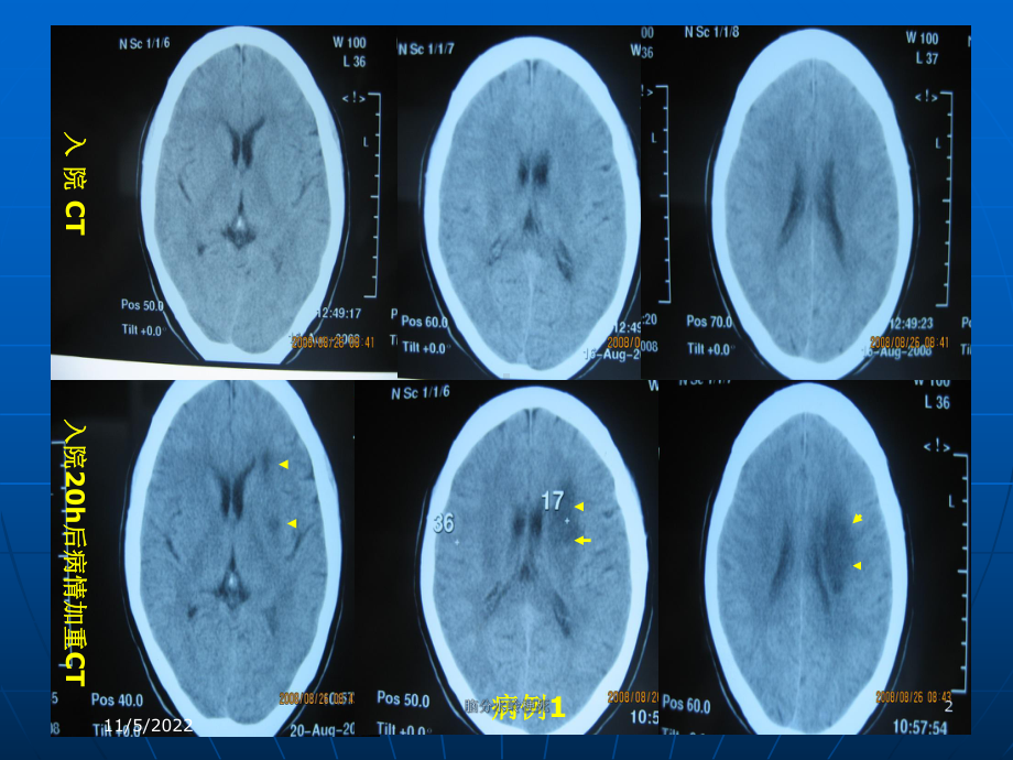 脑分水岭梗死培训课件.ppt_第2页