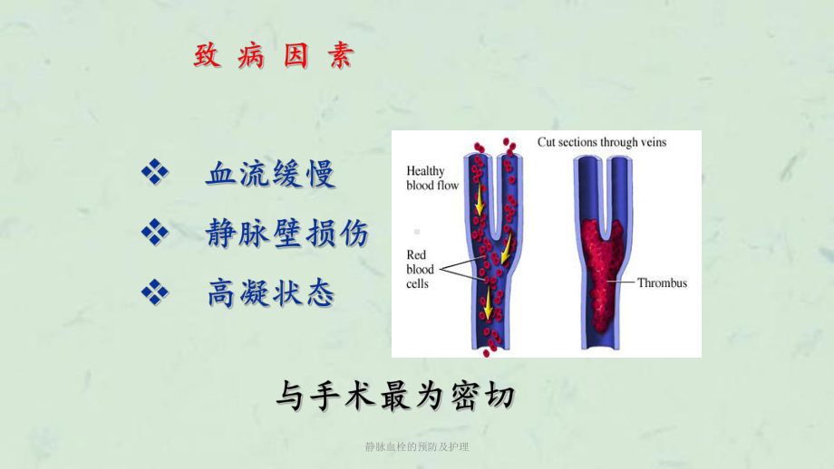 静脉血栓的预防及护理课件.ppt_第3页