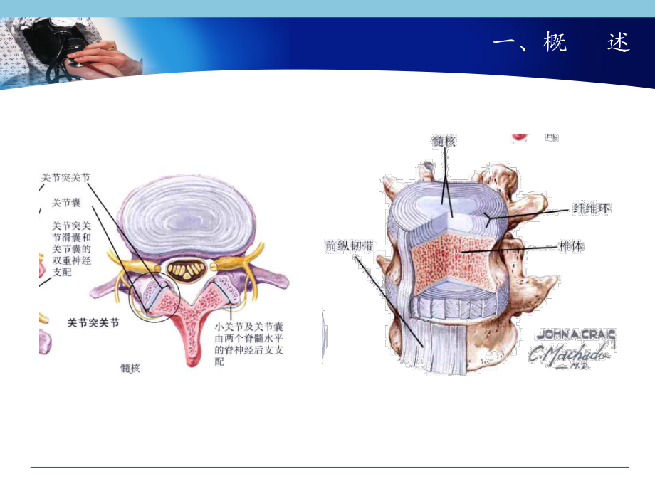 腰椎间盘突出康复主题讲座课件.ppt_第3页