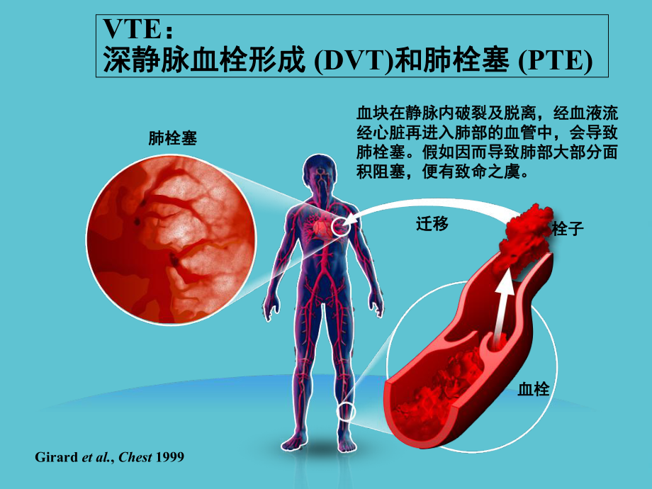 静脉血栓(VTE)防治解读课件-2.ppt_第2页