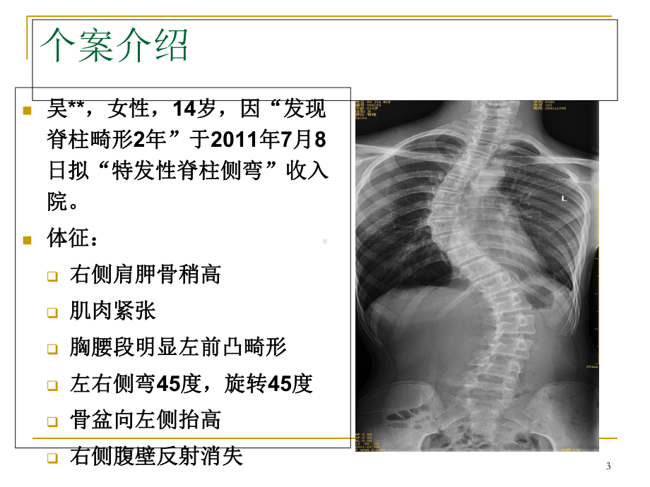 脊柱侧弯的个案护理教学课件.ppt_第3页