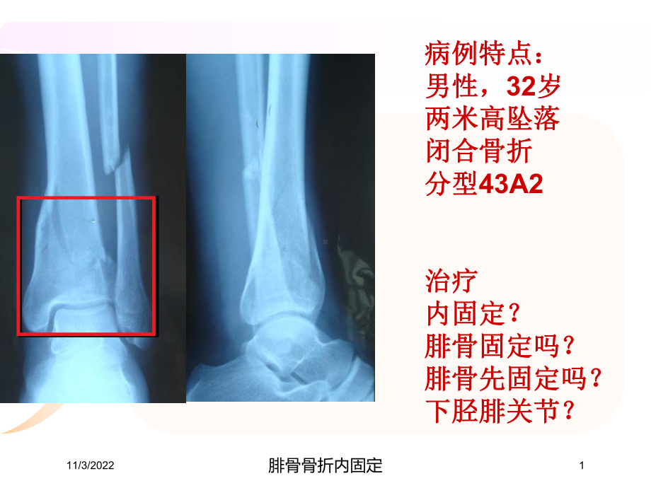 腓骨骨折内固定培训课件.ppt_第1页