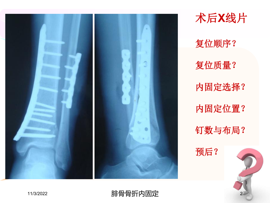 腓骨骨折内固定培训课件.ppt_第2页