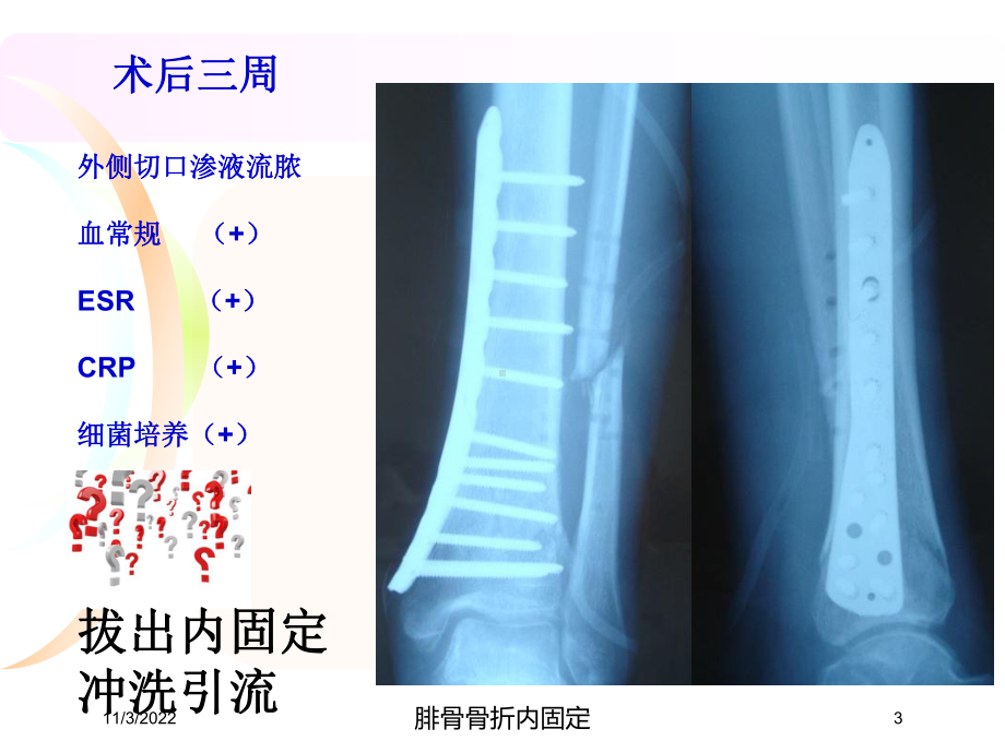 腓骨骨折内固定培训课件.ppt_第3页