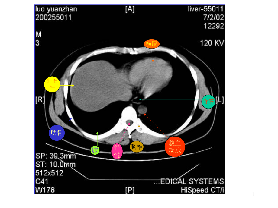 腹部CT彩色标识课件.ppt_第1页