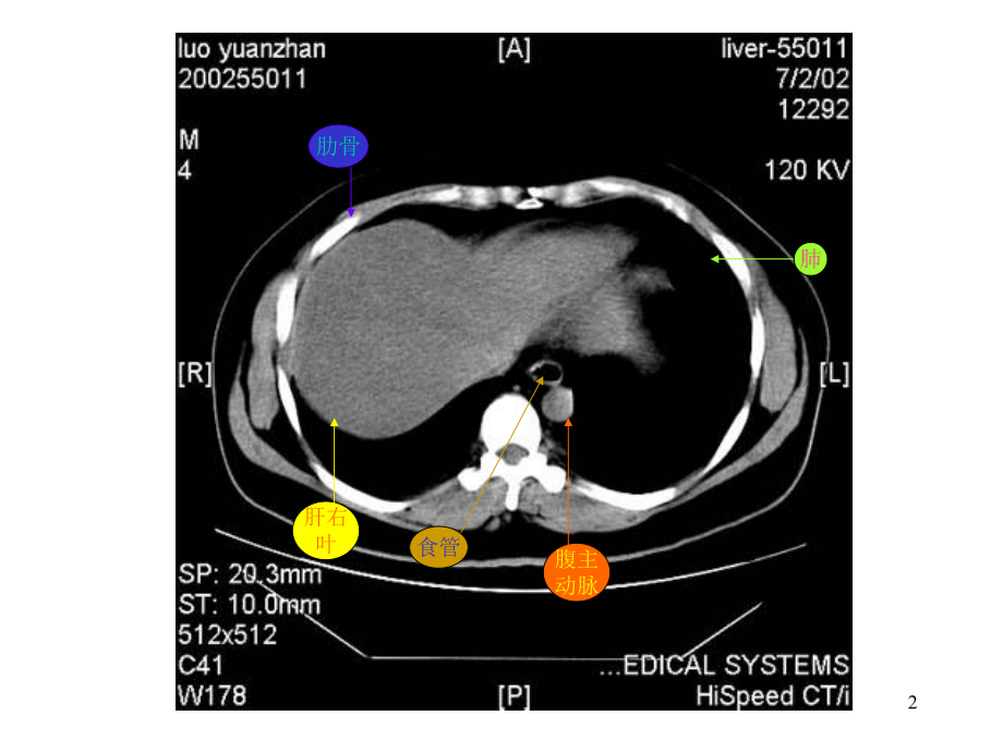 腹部CT彩色标识课件.ppt_第2页