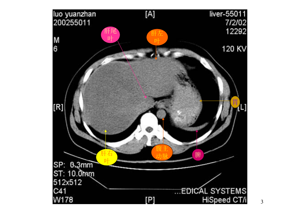 腹部CT彩色标识课件.ppt_第3页