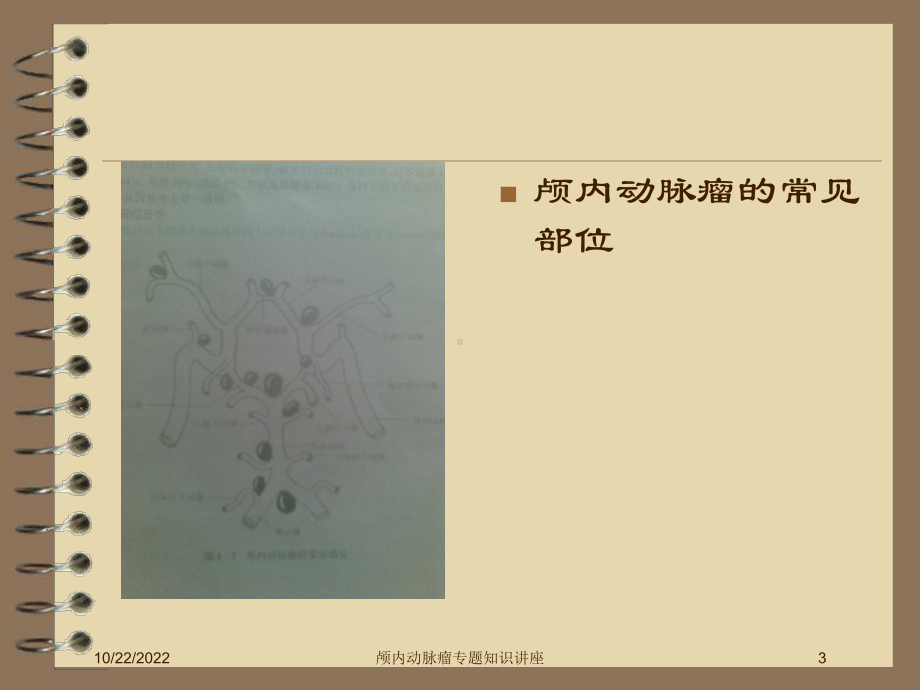 颅内动脉瘤专题知识讲座培训课件.ppt_第3页