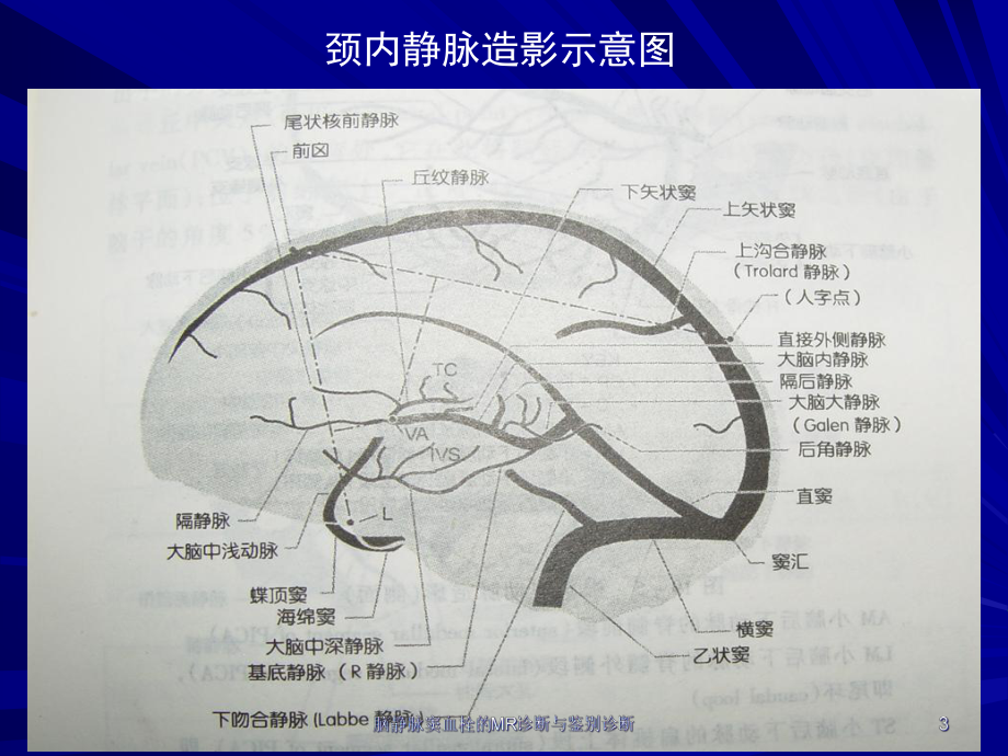 脑静脉窦血栓的MR诊断与鉴别诊断课件.ppt_第3页