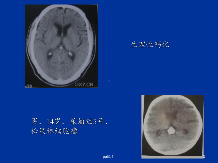 颅内钙化及其相关疾病-课件.ppt_第3页