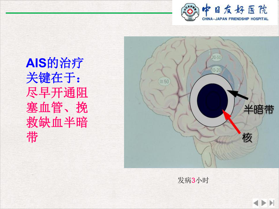 静脉溶栓的护理课件完整版.pptx_第3页