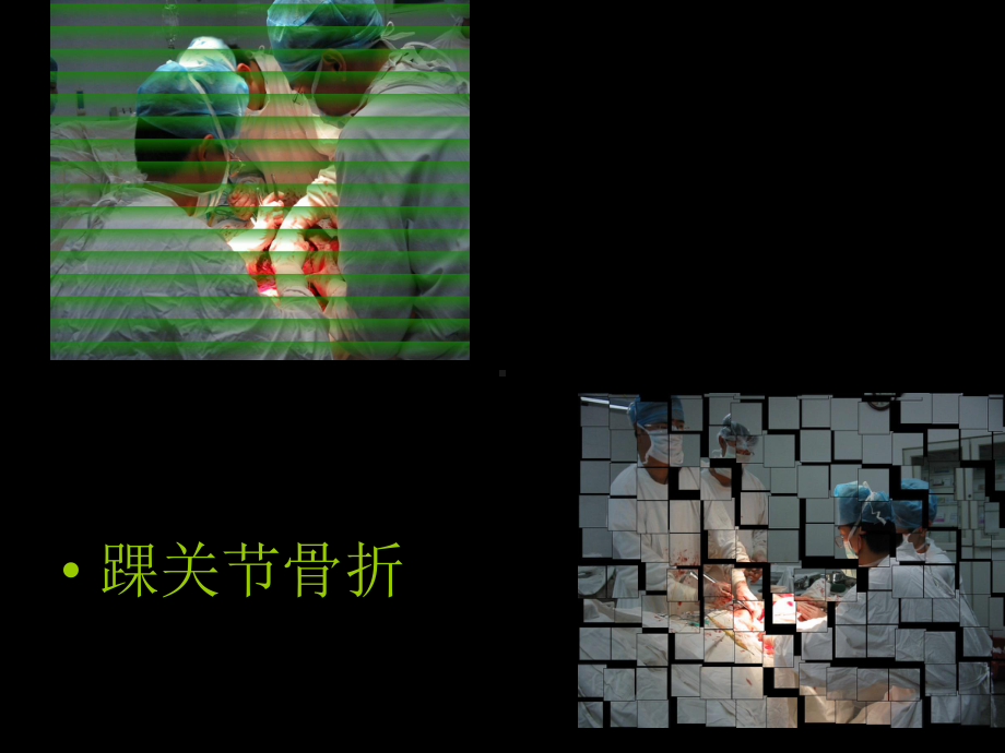 踝关节骨折成品课件.ppt_第1页