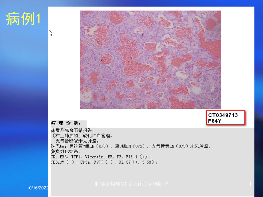 肺部错构瘤CT鉴别诊疗病例随访培训课件.ppt_第1页