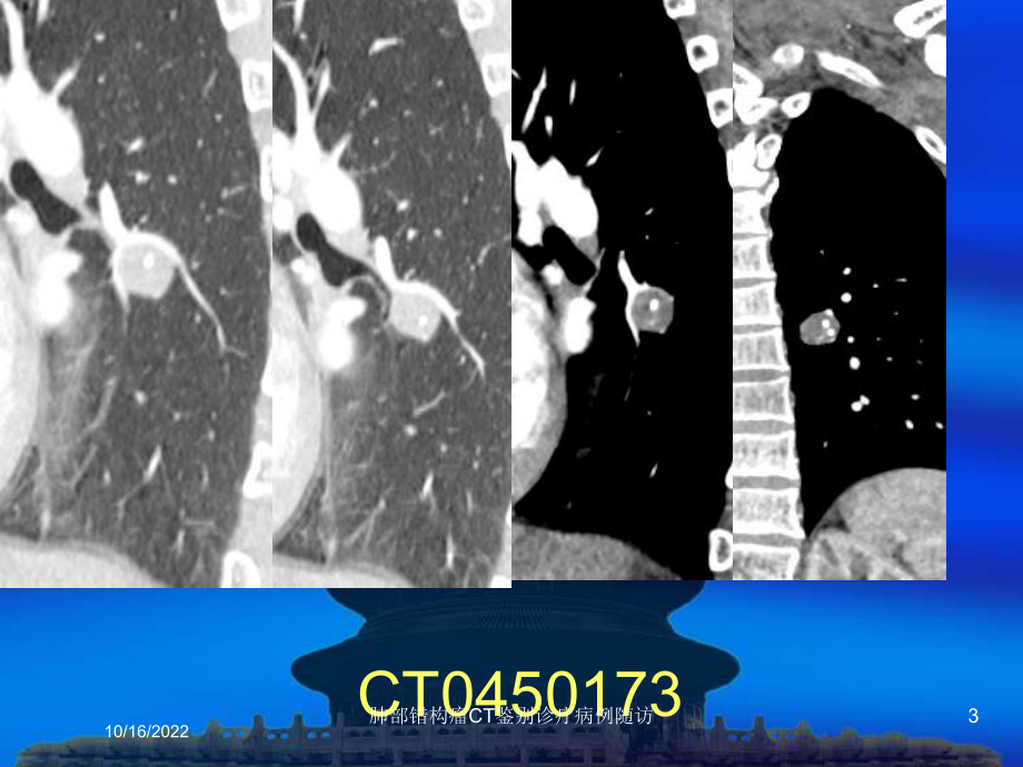 肺部错构瘤CT鉴别诊疗病例随访培训课件.ppt_第3页