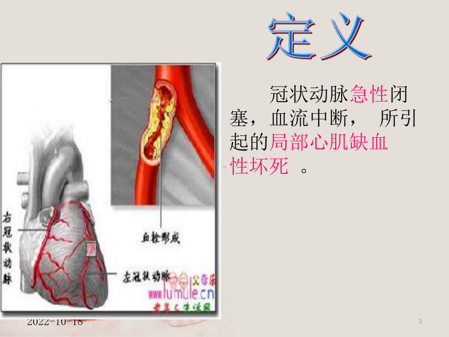 急性心肌梗死的溶栓护理查房课件.ppt_第3页