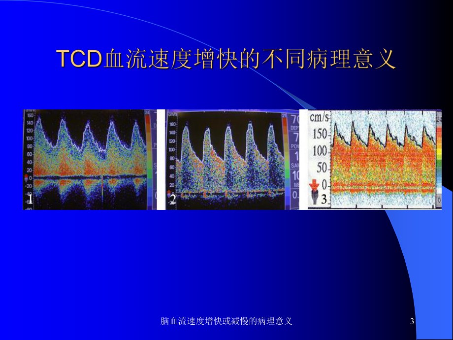 脑血流速度增快或减慢的病理意义课件.ppt_第3页