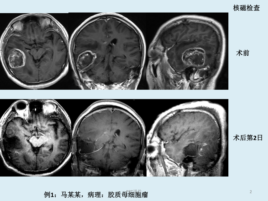 胶质瘤复发与放射性坏死鉴别-课件.ppt_第2页