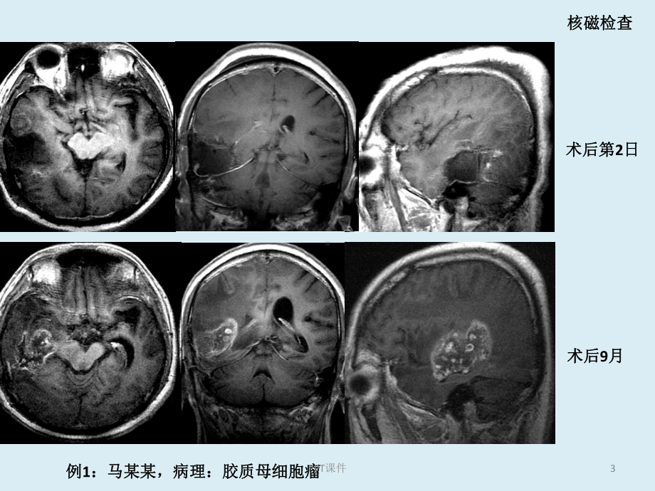 胶质瘤复发与放射性坏死鉴别-课件.ppt_第3页