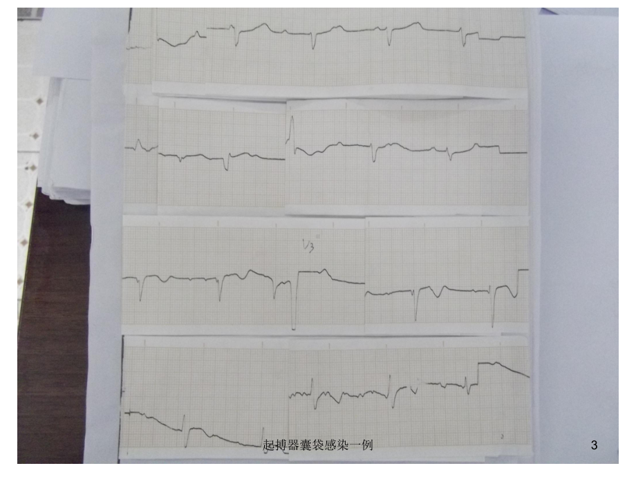 起搏器囊袋感染一例培训课件.ppt_第3页